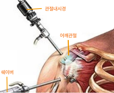 어깨 관절경 시술 / 수술