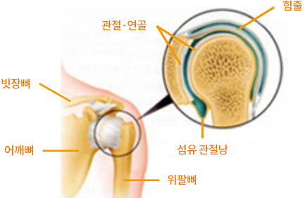 유착성피막염 ( 오십견 )