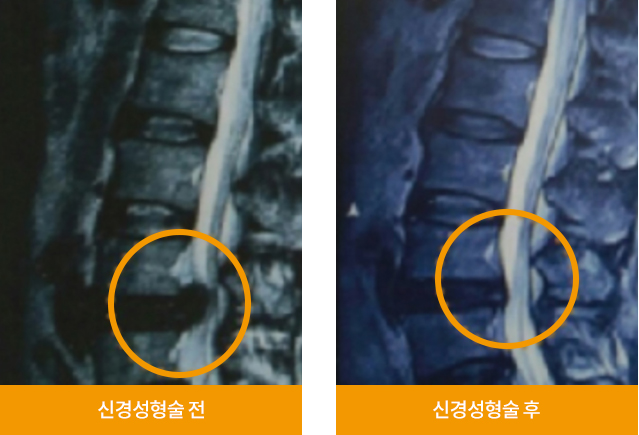 경피적 경막외 신경성형술