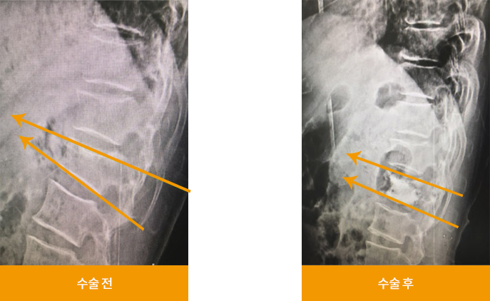 압박골절 시술